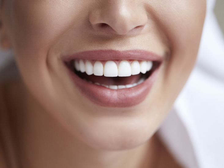 What are Dental Veneers